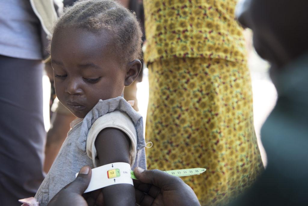 Small child being treated for malnutrition in South Sudan
