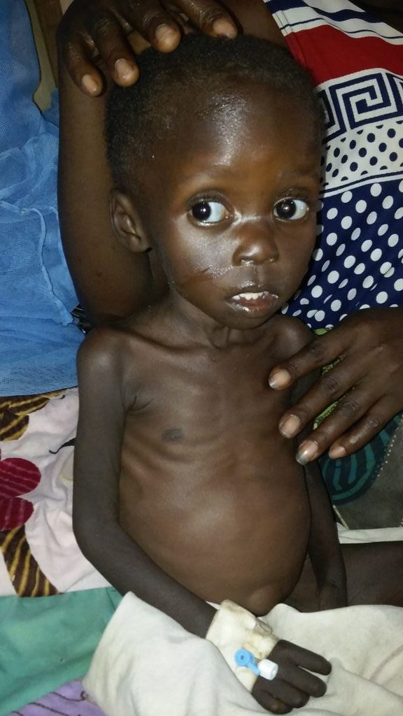 Baby Jenifer is Malnourished. She is here with her mother 