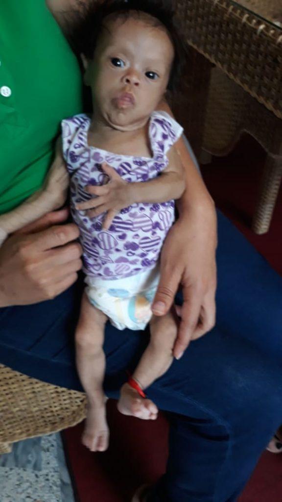 An image of baby Ema. She has down syndrome and came to Columbia malnourished