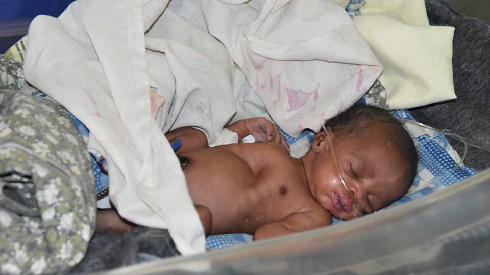 A 32 weeks old baby is being treated for malnourishment at the Mother of Mercy Hospital in South Sudan in January 2017 