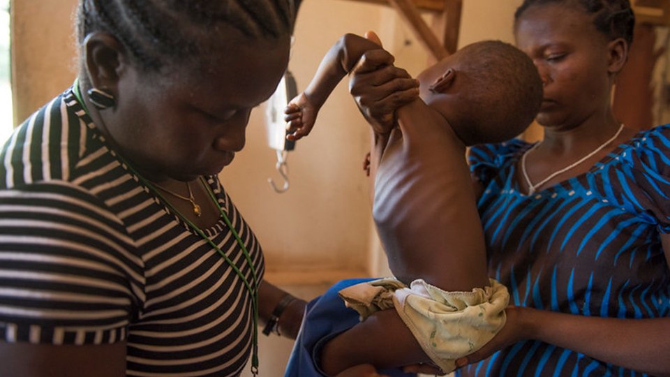 A severely malnourished boy is being assessed when holding by his mother in Nzara in South Sudan in December 2017 